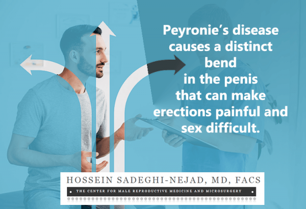 Peyronie's disease causes a distinct bend in the penis that can make erections painful and sex difficult.