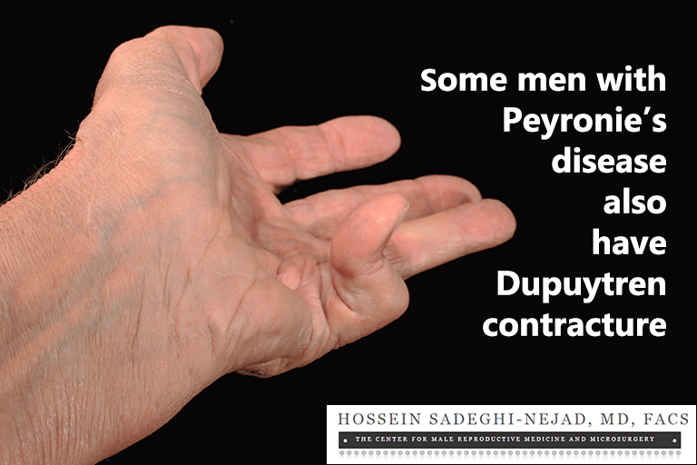 Some men with Peyronie's disease also have Dupuytren's contracture.