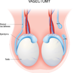 Illustration of testes, epididymides, and vasa deferentia. One vas deferens has been cut. The other vas deferens has been cut and tied closed.