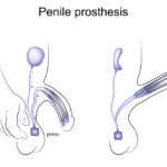 Illustration of a penile prosthesis